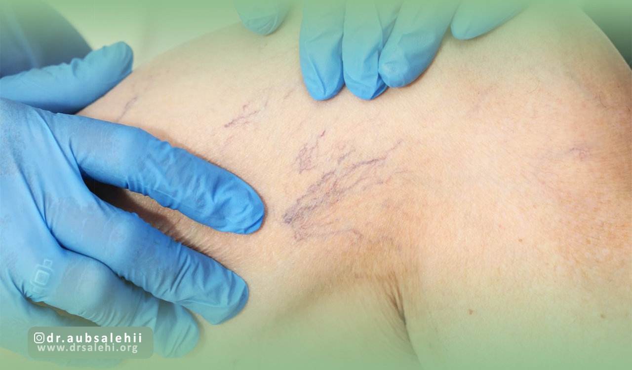 درمانهای دارویی واریس پا