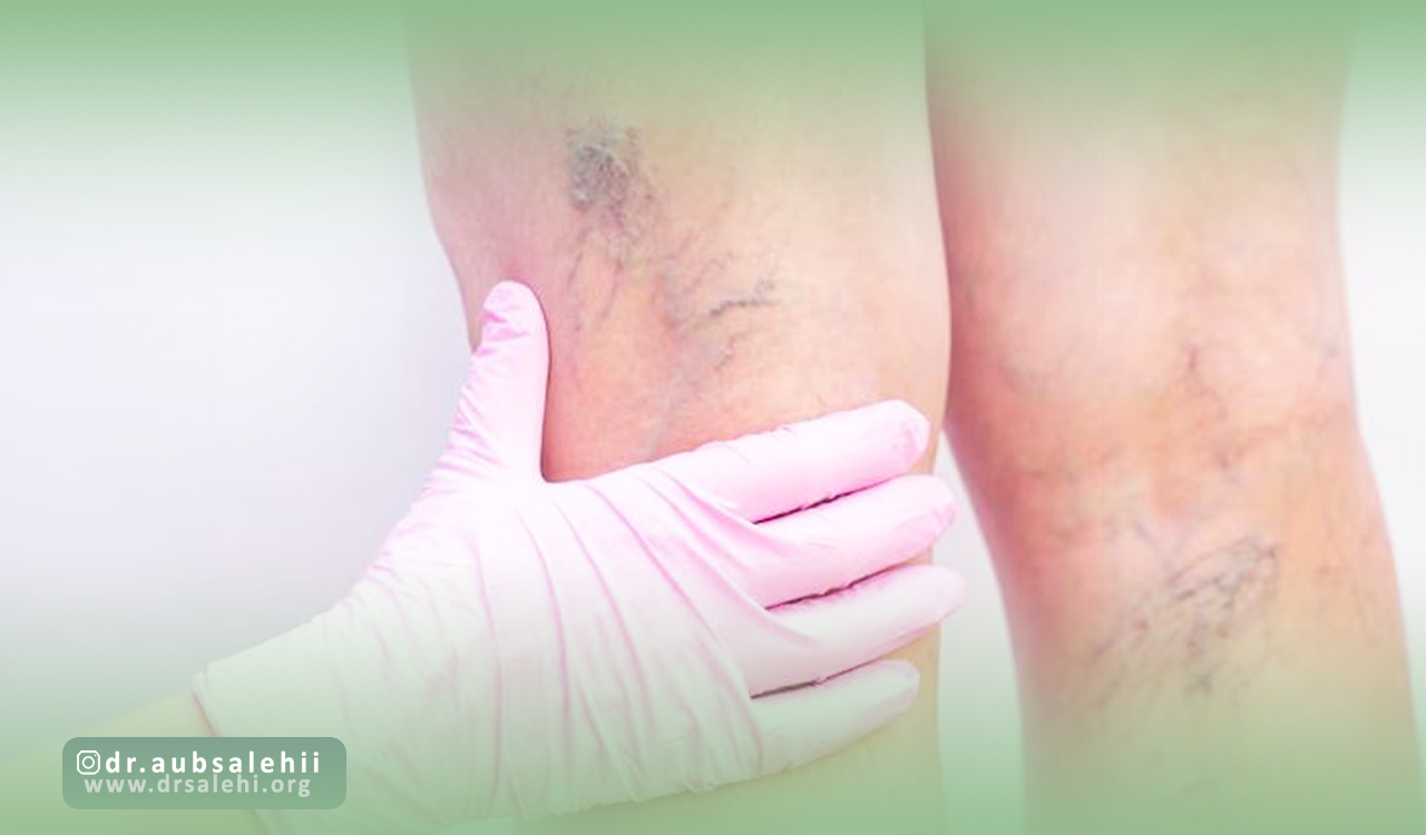 عوارض احتمالی درمانهای واریس پا