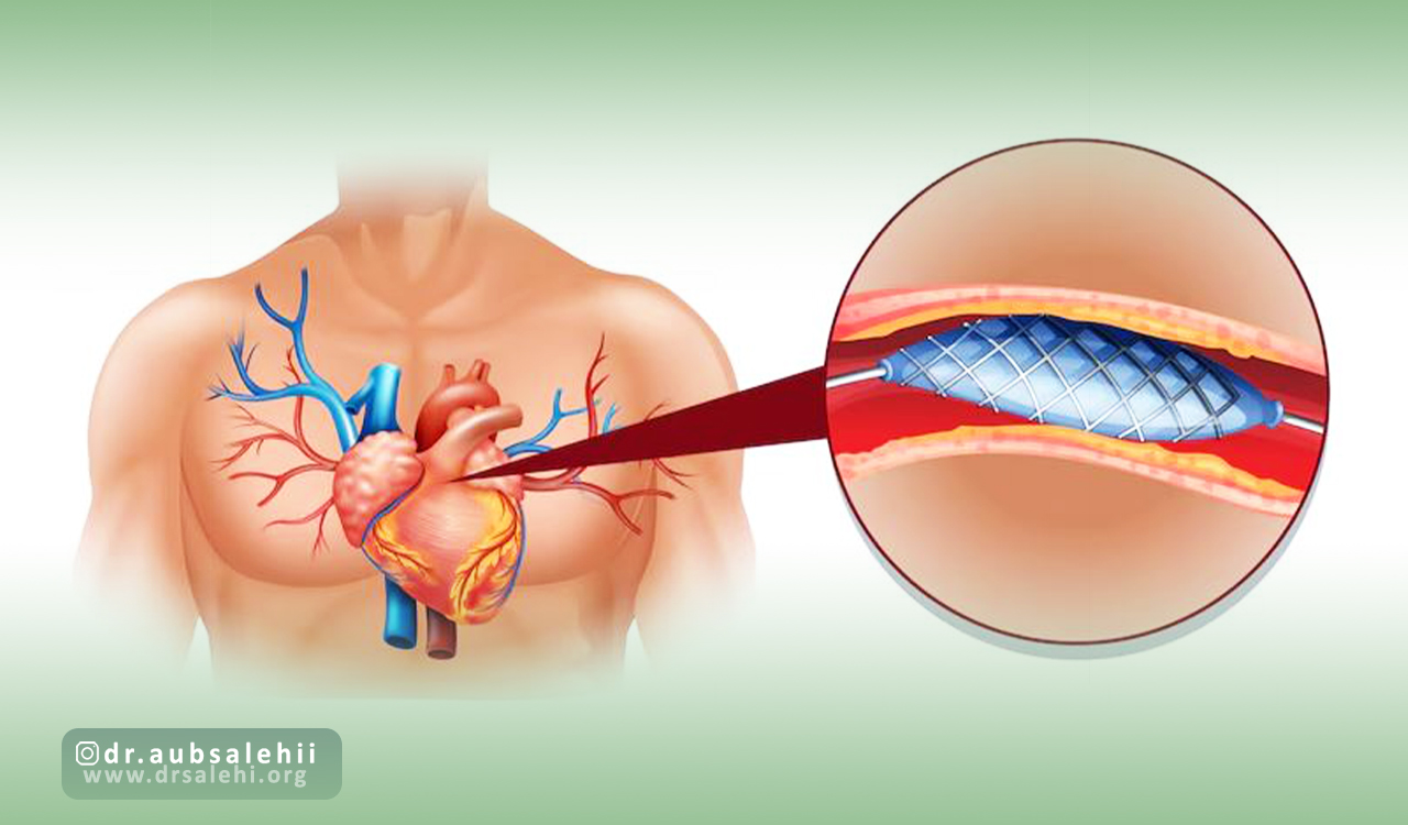 معایب استفاده از استنت قلب