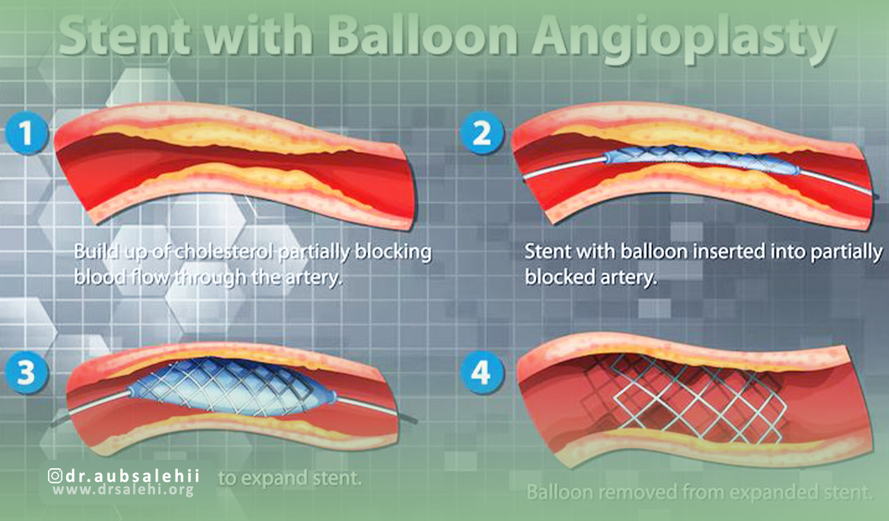 بیماریهای شریانی در سایر اندامها (آنژیوپلاستی محیطی)