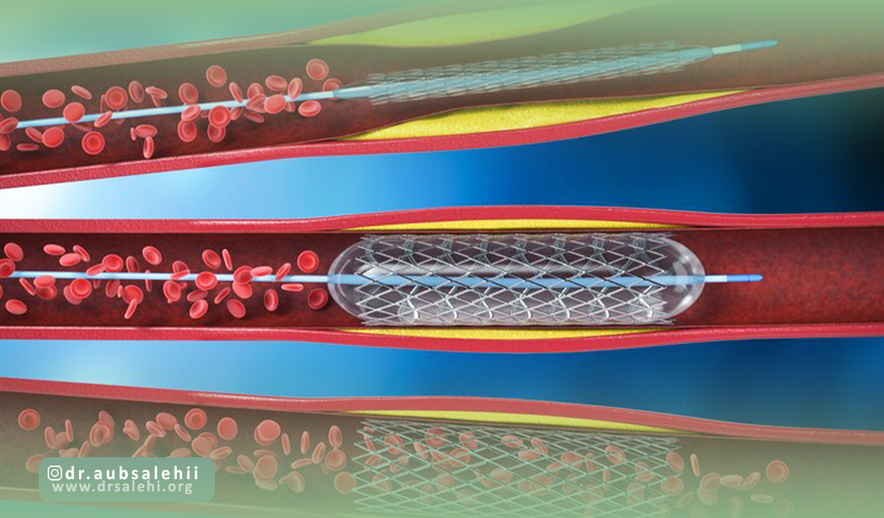مراقبتهای پس از آنژیوپلاستی