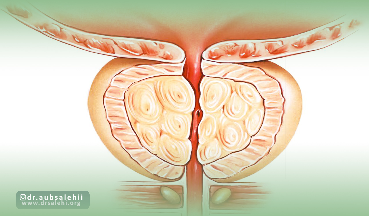نحوه انجام آنژیوگرافی پروستات