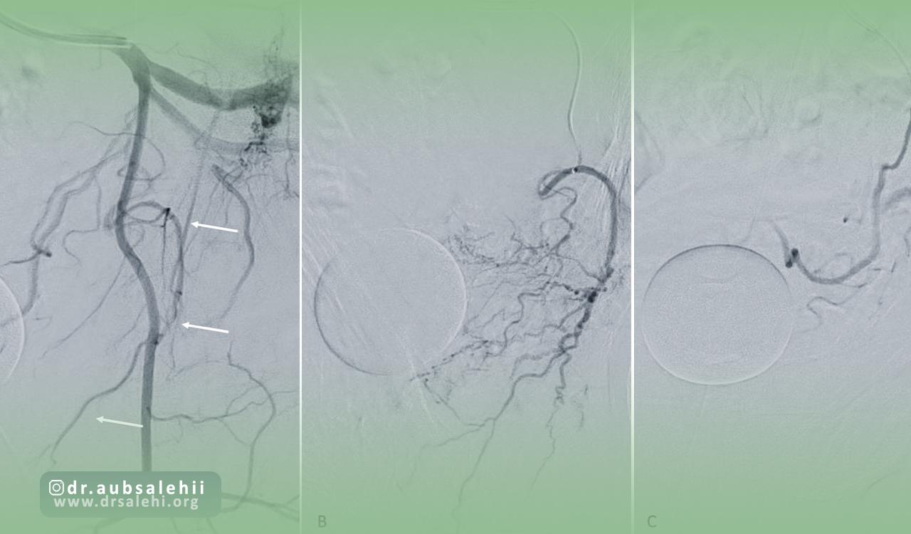 عوارض شایع آنژیوگرافی پروستات