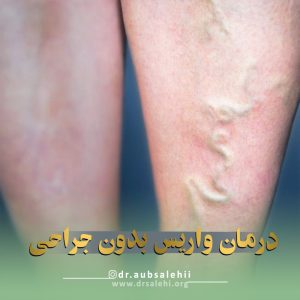 درمان واریس پا بدون جراحی